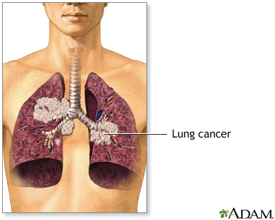 lung cancer cells
