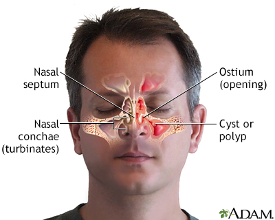 Nasal cyst on sale