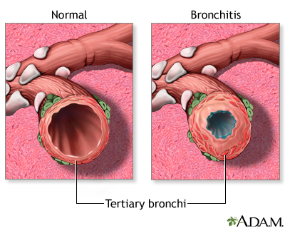 Bronchitis and Normal Condition in Tertiary Bronchus - Illustration Thumbnail
                      