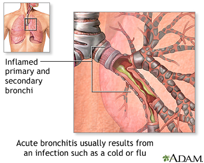Causes of acute bronchitis - Illustration Thumbnail              