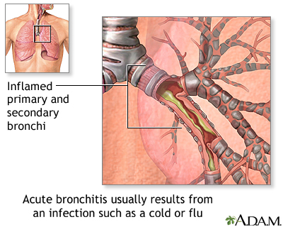 Causes de la bronchite aiguë