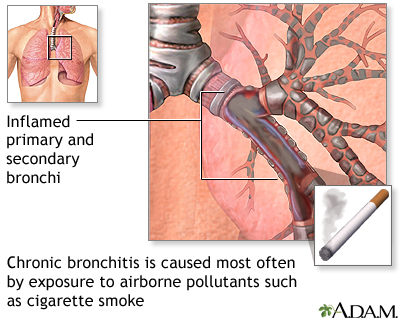 Causes of chronic bronchitis