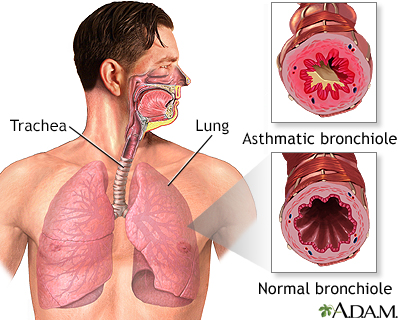 default In Depth Reports Asthma in adults InDepth