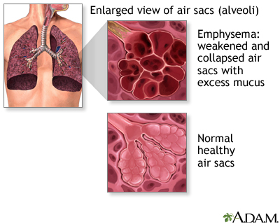 COPD (Chronic Obstructive Pulmonary Disorder) - Illustration Thumbnail
              