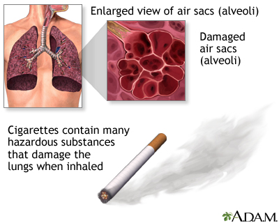 Smoking and COPD (chronic obstructive pulmonary disorder) - Illustration Thumbnail
              