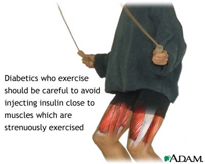 Exercise and diabetes