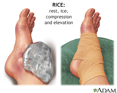 Sprained Ankle Treatment  Foot Ankle Broken Injuries Diagnosis