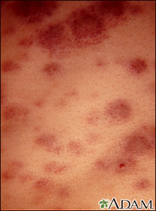 leukemia symptoms skin