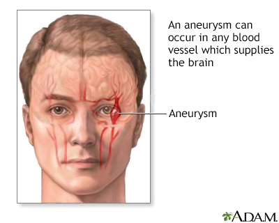 Cerebral aneurysm - Illustration Thumbnail              