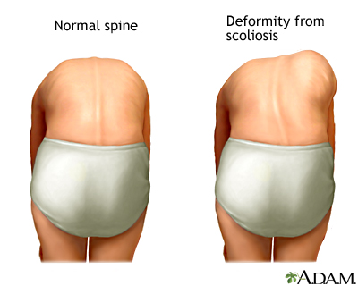 Scoliosis Information  Mount Sinai - New York