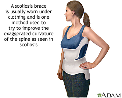 Lumbar (A), Thoracolumbar (B) and Thoracic (C) Boston Brace