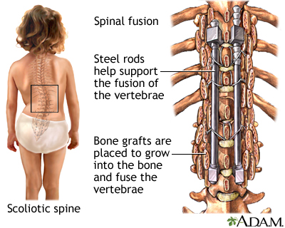 Sleeping With Scoliosis and Spinal Fusion