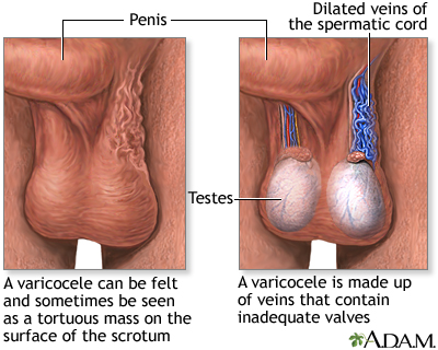 Varicocele: Video, Anatomy, Definition & Function | Osmosis