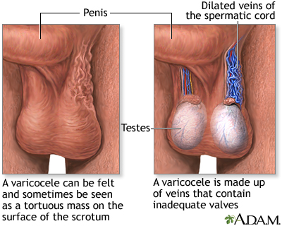 Varicocele - Illustration Thumbnail
                      