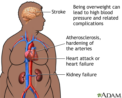 How high does blood pressure have to be to cause deals a stroke