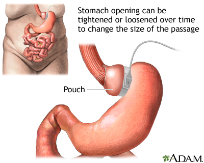 gastric