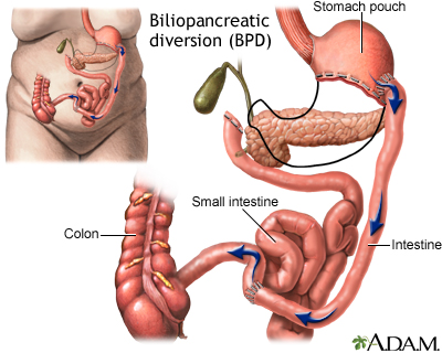 Biliopancreatic diversion (BPD)