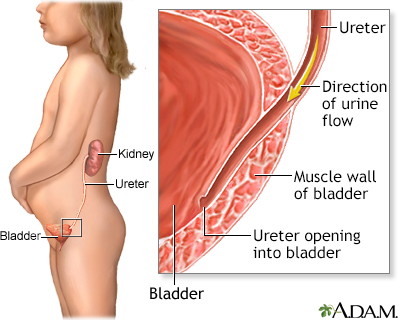 Reflux Nephropathy Information Mount Sinai New York