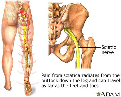 Sciatica – Symptoms and Causes