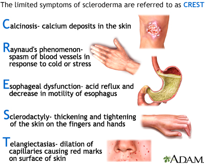 systemic scleroderma hands