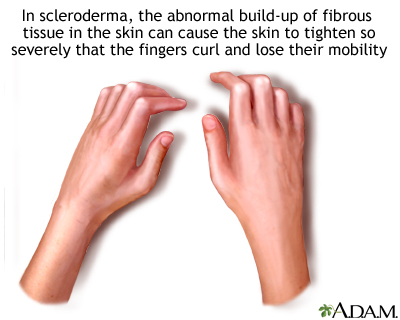 Sclerodactyly - Illustration Thumbnail
                      