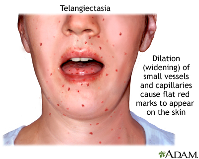 ataxia telangiectasia patients