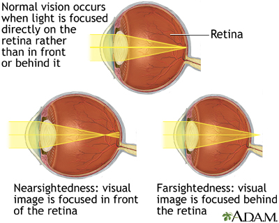 Normal, nearsightedness, and farsightedness - Illustration Thumbnail              