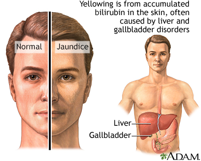 yellow skin jaundice