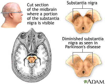 Substantia nigra and Parkinson disease - Illustration Thumbnail
              