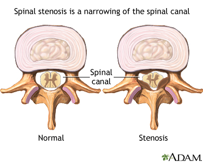 Spinal stenosis - Illustration Thumbnail
              