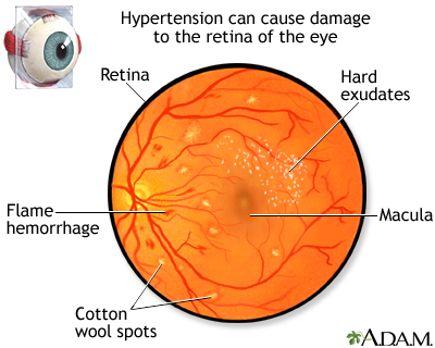 High blood pressure and eye disease Information