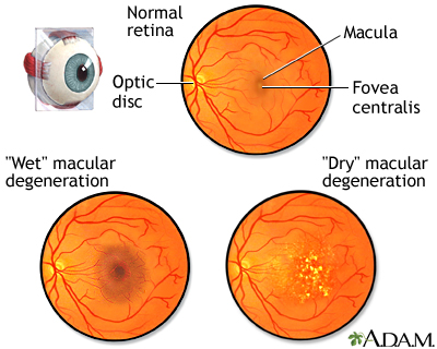 Macular degeneration - Illustration Thumbnail
              