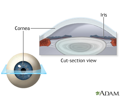 Lasik eye surgery - series - Normal anatomy - Presentation Thumbnail
              