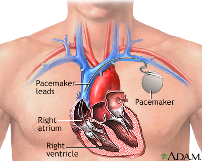 Pacemaker - Illustration Thumbnail                    