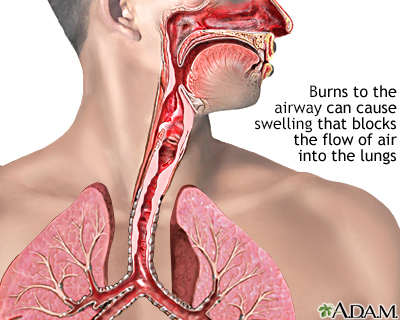 Airway burn