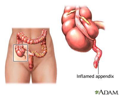 Appendicitis Information