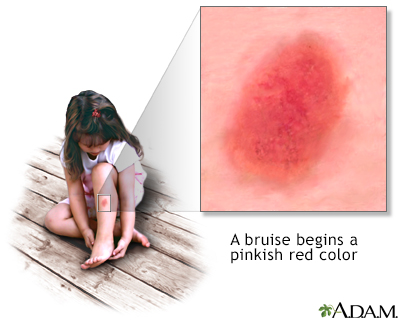 Bruise healing - series