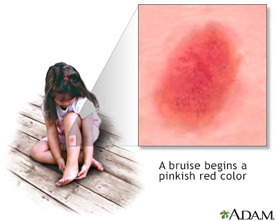 Bruise on female skin. Injection bruises after Pulmonary Embolism