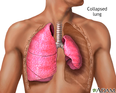 Collapsed lung, pneumothorax - Illustration Thumbnail
              