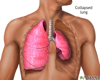 Collapsed lung, pneumothorax - Illustration Thumbnail              