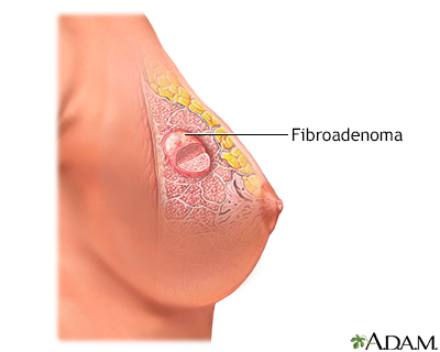 Breast lump Information Mount Sinai New York