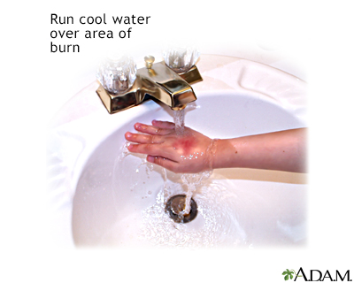 Minor burn treatment - run under cool water - Presentation Thumbnail
                    