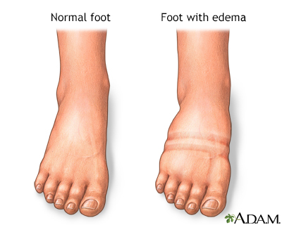 Foot, leg, and ankle swelling Information