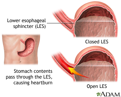 heartburn location