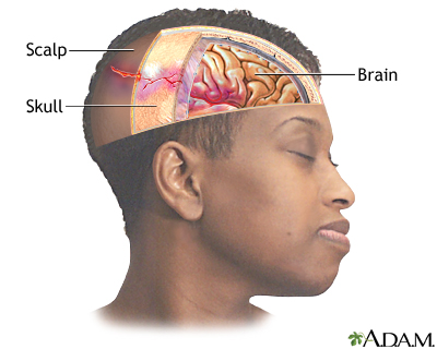 penetrating skull fracture