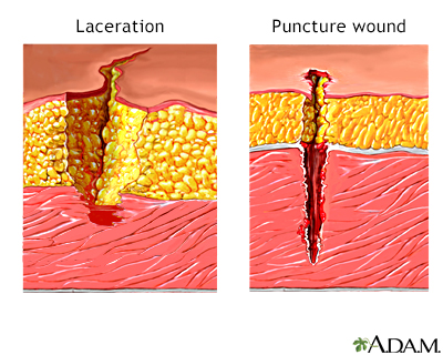 Cuts and puncture wounds Information Mount Sinai New York