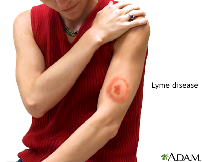 Lyme disease - Illustration Thumbnail
                      