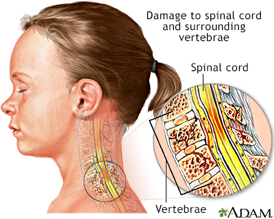 cervical spine damage symptoms