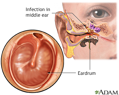Infection de l'oreille moyenne