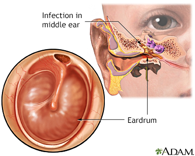 Close up of abscess Inflammation on the ear, area of suppuration.  Collection of pus that has built up within the tissue of the body. Photos